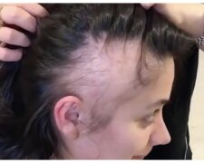 Frau mit Haarausfall. Quelle: Youtube Screenshot