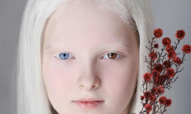 "Unauffälliges Aussehen": wie ein Albino-Mädchen mit verschiedenen Augen aussieht