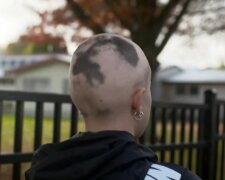 Alopecia. Quelle: Youtube Screenshot