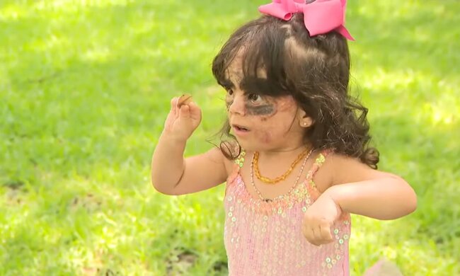 Mädchen mit Muttermal im Gesicht (Symbolbild). Quelle: Youtube Screenshot