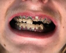 Probleme mit den Zähnen. Quelle: Youtube Screenshot