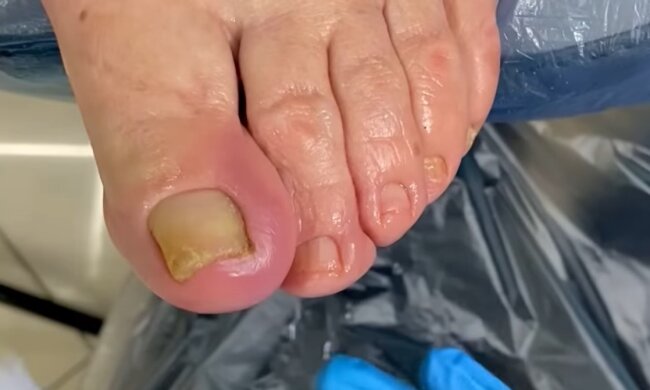 Nägel (Symbolbild). Quelle: Youtube Screenshot