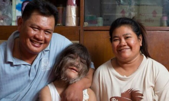 Sie wurde in das Guinness-Buch der Rekorde aufgenommen: Wie sieht ein wolfsähnliches Mädchen aus