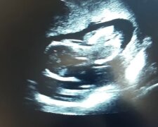 Ärzte bemerkten seltsame Konturen im Ultraschallbild des Babys: Jetzt sehen Passanten das Mädchen überrascht an