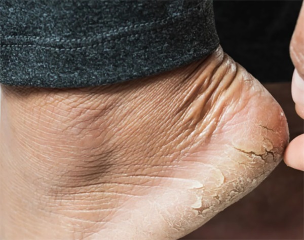 Warum reißen sich die Fersen und was kann man damit tun. Uberalles